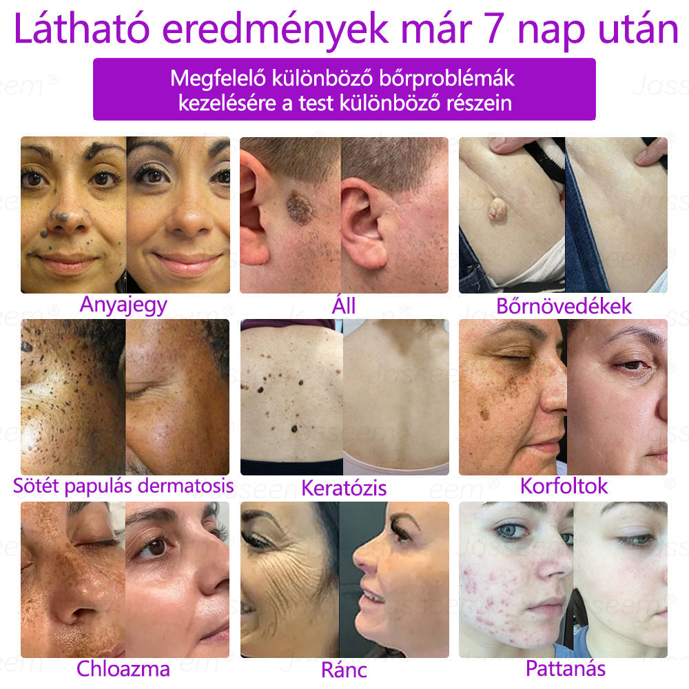 𝐉𝐚𝐬𝐬𝐞𝐞𝐦® Fejlett, nem invazív bőrjavító CO₂ lézeres toll 🎉 (Gyengéden eltávolítja a szemölcsöket, anyajegyeket, öregségi foltokat és bőrkinövéseket – fájdalom és gond nélkül!)