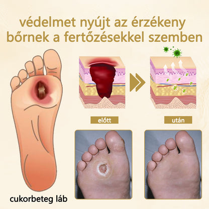 Timilk® Diabetikus lábgyógyító spray - Méhméreggel átitatott